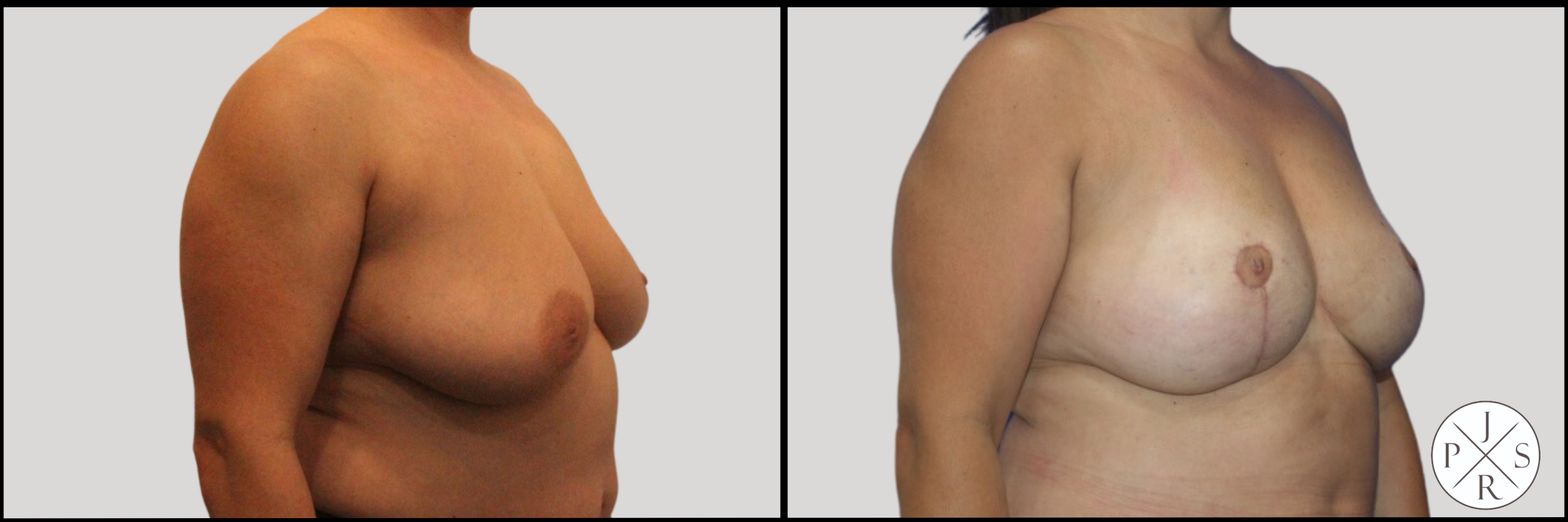 Fat Transfer Breast Augmentation Before & After Image